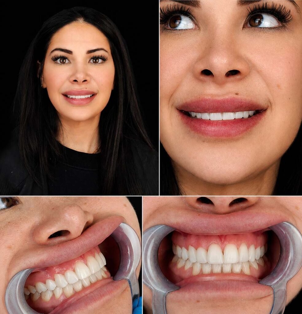 composite veneers