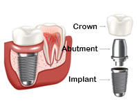 dental implant in tijuana