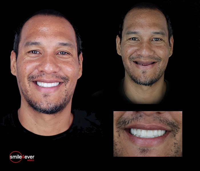 Dental patient before and after treatment showing results at Tijuana dental prices