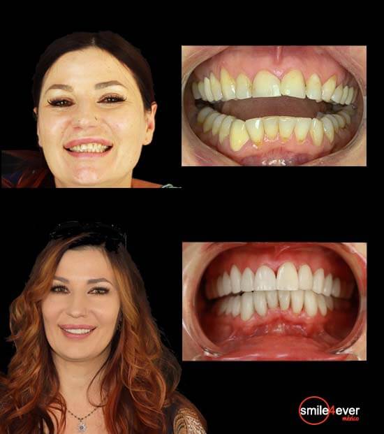 Patient with complete smile makeover in Tijuana