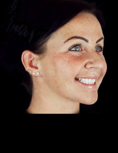 dental implants in mexico case